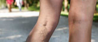 veins