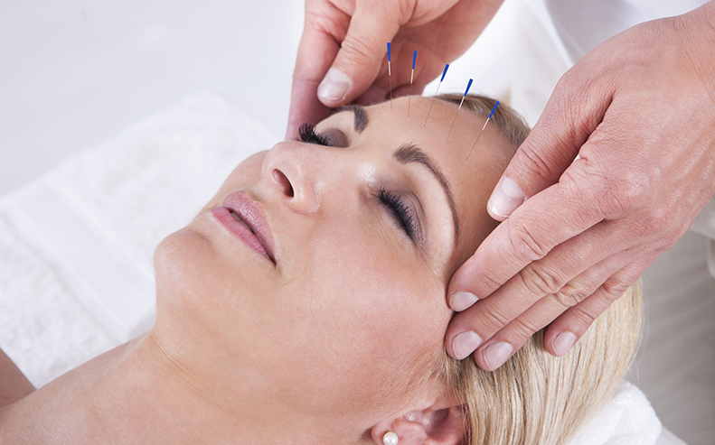 acupuncture