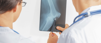 doctors examining knee x-ray for signs of osteoporosis