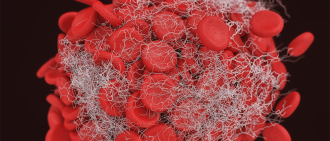 blood clot