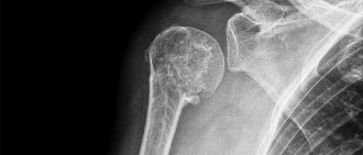 shoulder x-ray