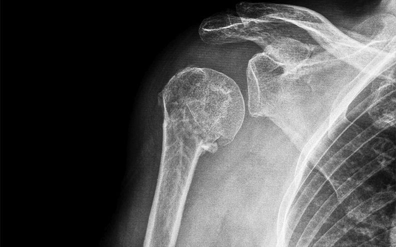 shoulder x-ray