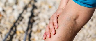 varicose veins