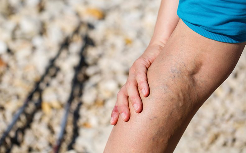 varicose veins