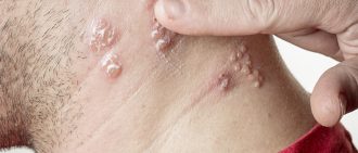 shingles