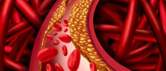What Is Atherosclerosis?