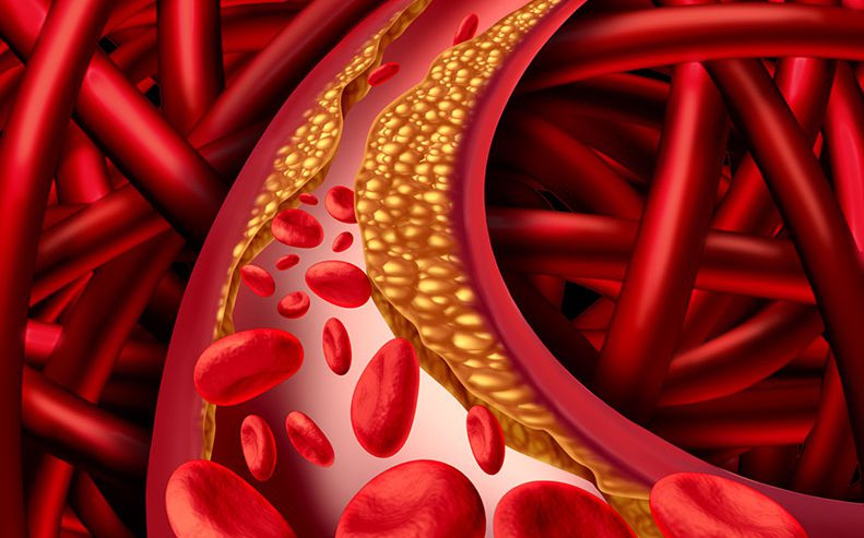 What Is Atherosclerosis?