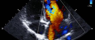 echocardiogram