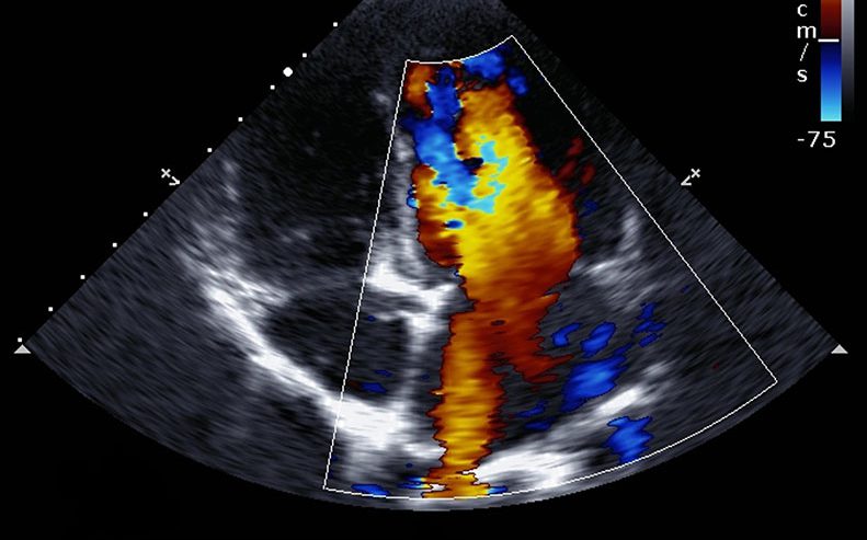echocardiogram