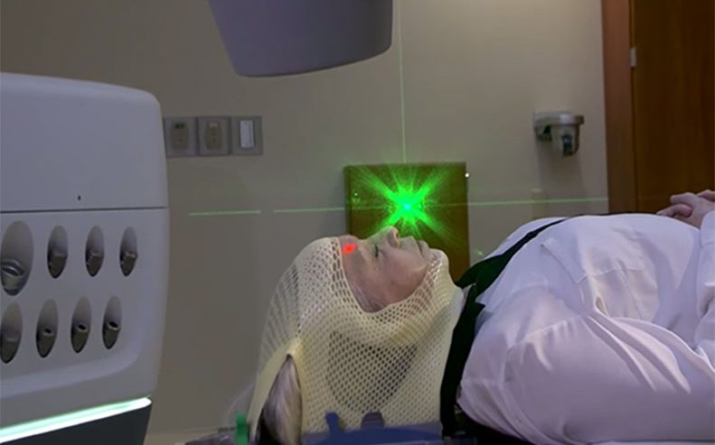 srs radiosurgery