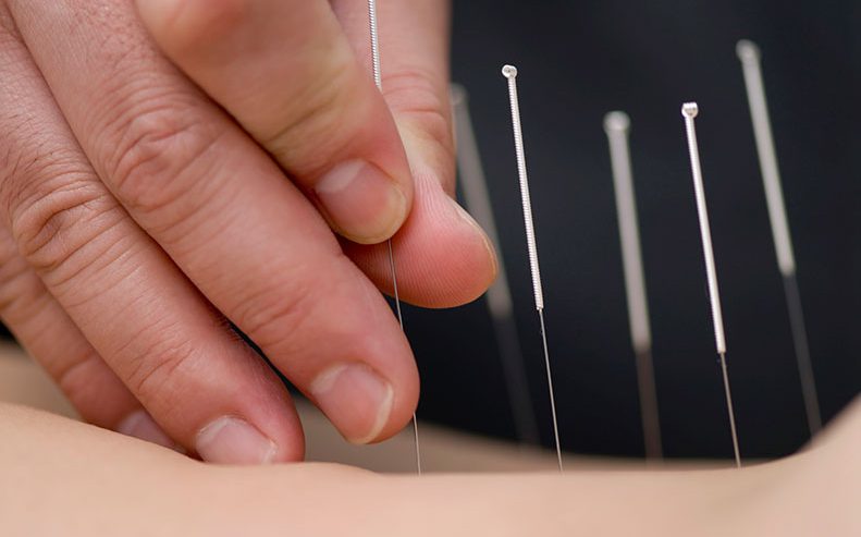 acupuncture