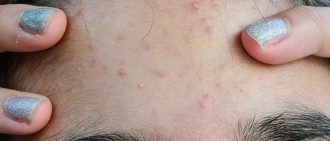acne