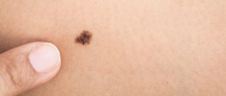 birth mark