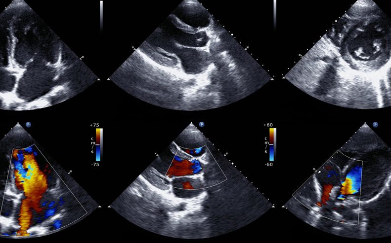 The results of an echocardiogram.