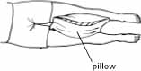 After hip replacement surgery, it's especially important to place a pillow between your knees, especially when lying on your side.