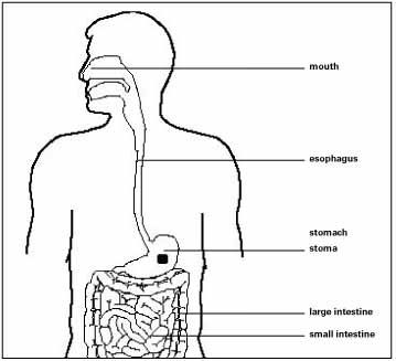 An illustration of the stoma site -- the insertion point of the feeding tube in the stomach.