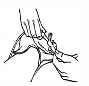 An illustration showing how to attach the feeding tube to the food container.
