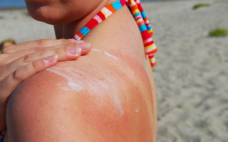 Learn how to tell the difference between sunburn and sun poisoning