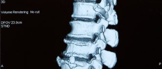 Spinal stenosis