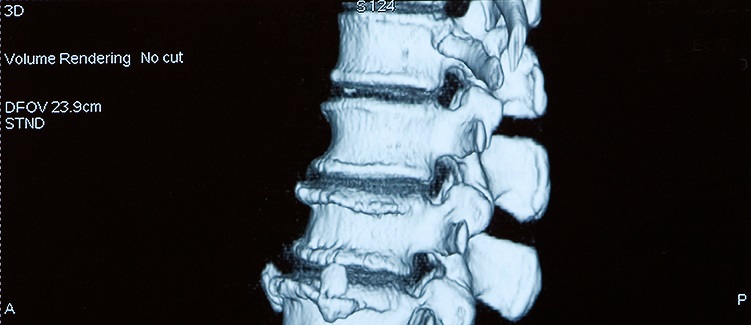 Spinal stenosis