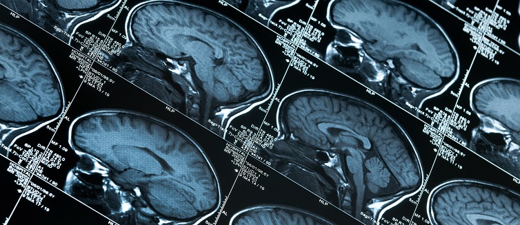 Brain MRI