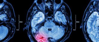 How long does a stroke last?