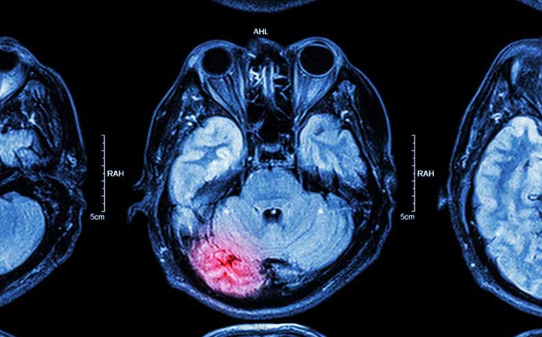 How long does a stroke last?
