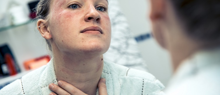 Learn more about rosacea