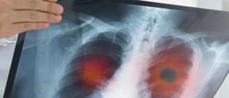 UPMC Doctor Leads Endobronchial Valve Research