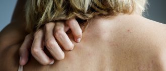 Lupus rash treatment