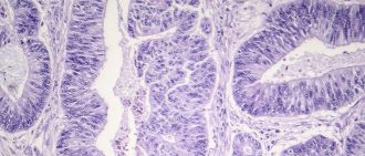 Esophageal squamous cell carcinoma