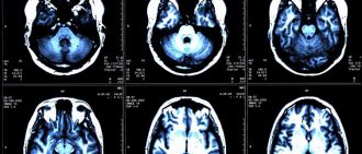 multiple sclerosis treatment 50ph