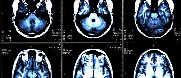 multiple sclerosis treatment 50ph