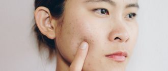 Hormonal Acne