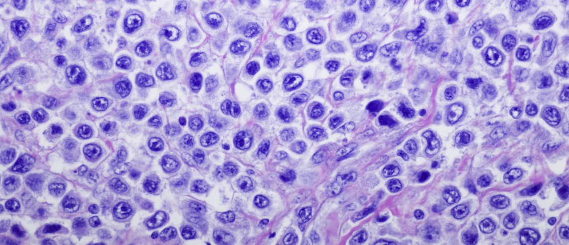 Learn more about Hodgkin's Lymphoma