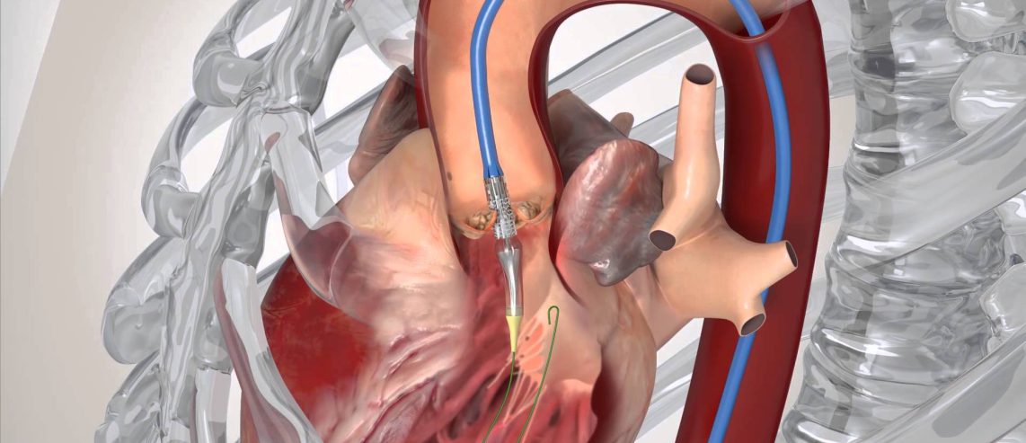 TAVR