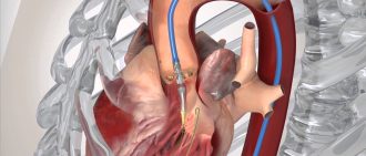 TAVR