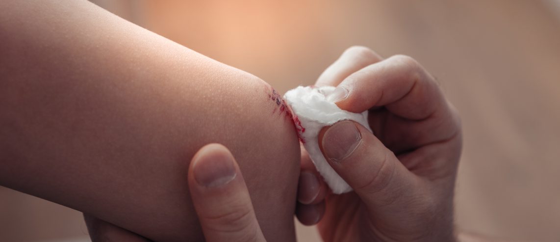 Cleaning wound