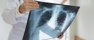 doctor checking chest x-ray film