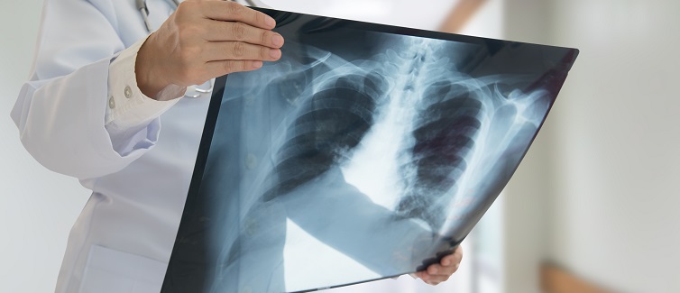 doctor checking chest x-ray film