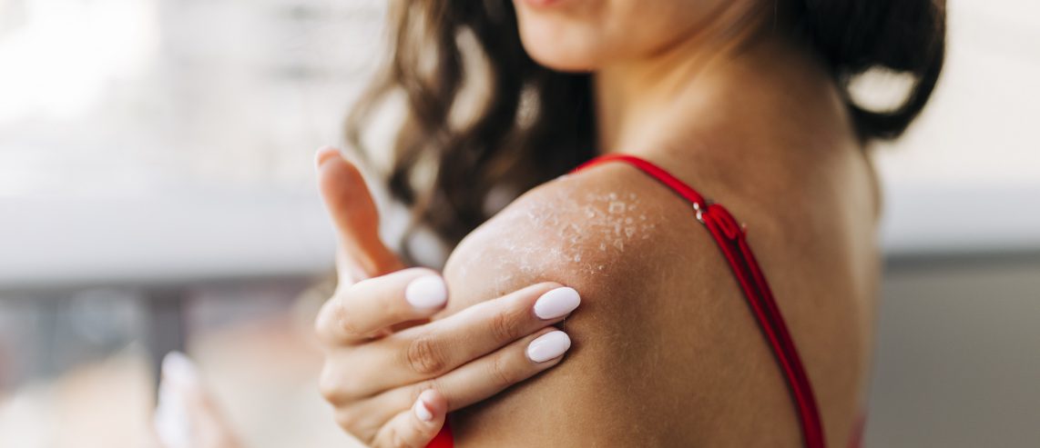 How To Treat Sun Blisters