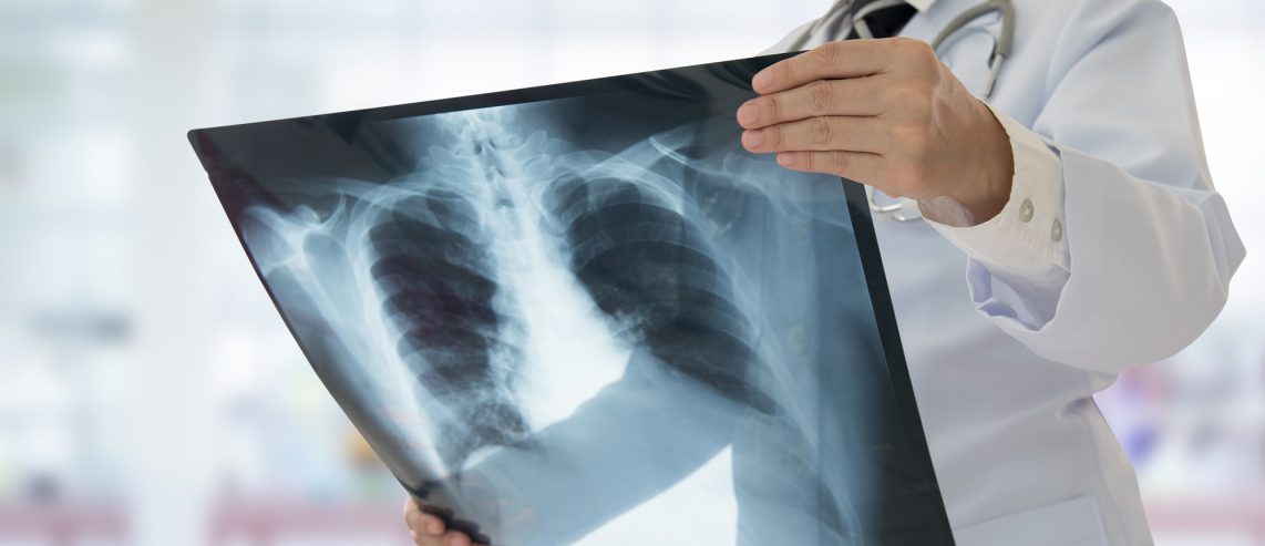 Lung Cancer Screening