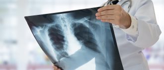 Lung Cancer Screening
