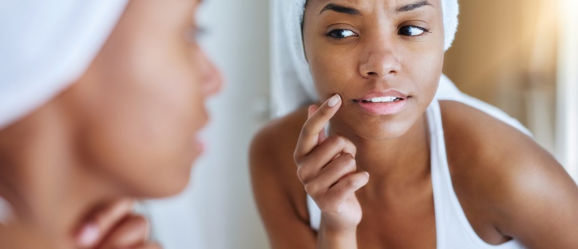 How to Treat Cold Sores