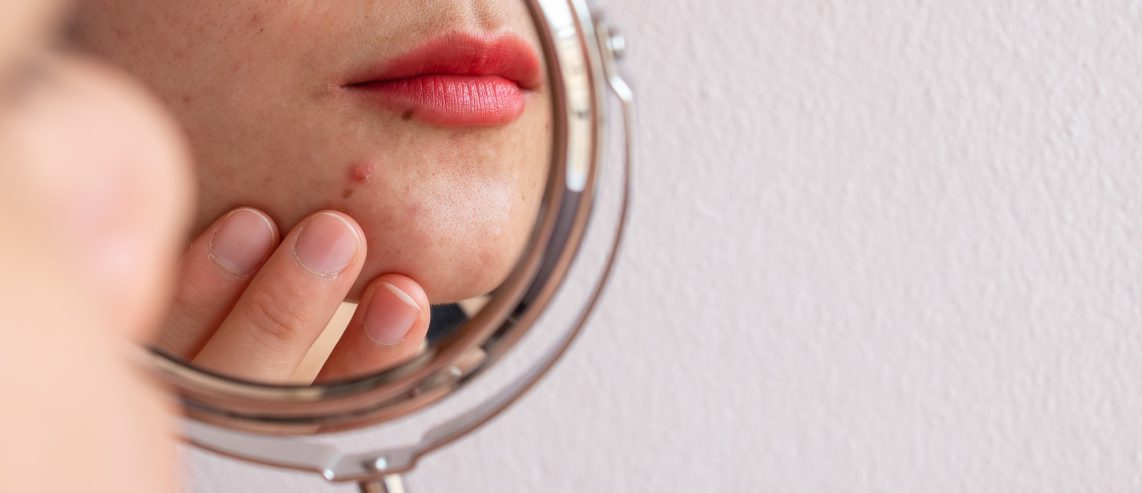 Cystic Acne Treatment: Ashlynn’s Story