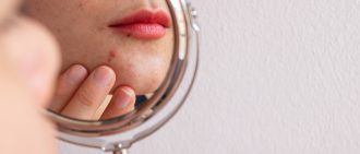 Cystic Acne Treatment: Ashlynn’s Story