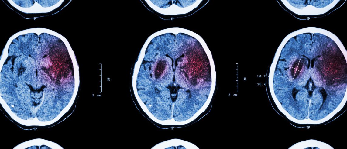 Learn more from Chuck's recovery from ischemic attack.