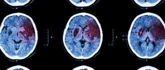 Learn more from Chuck's recovery from ischemic attack.
